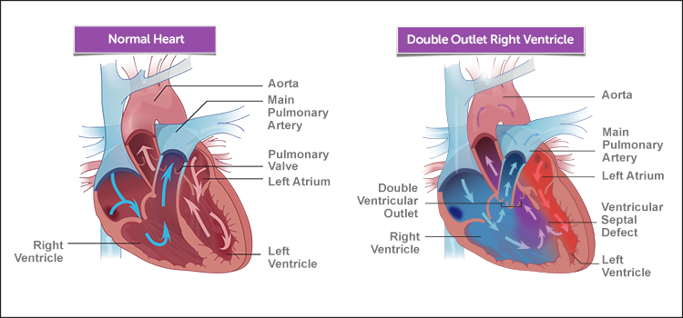 Double outlet right ventricle (DORV)