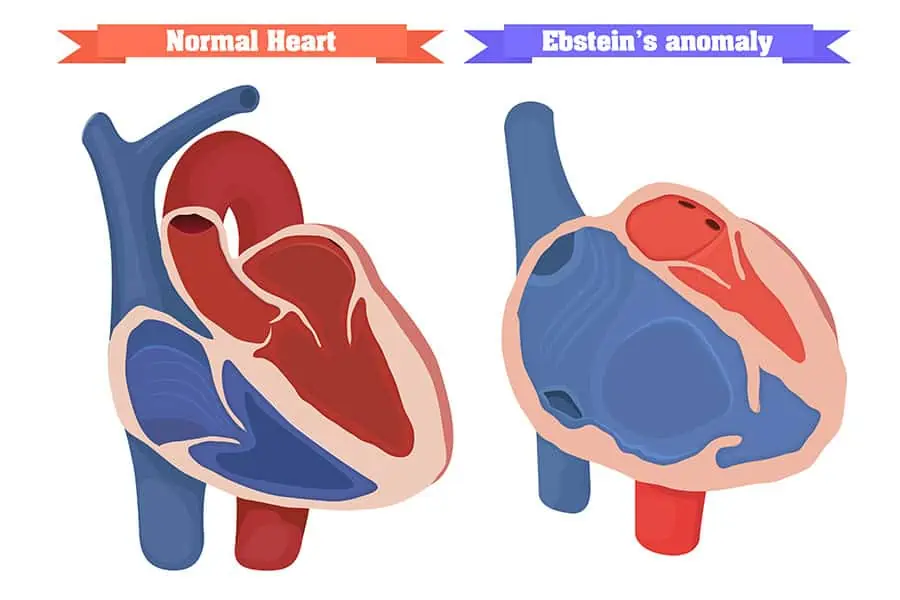 Aortopulmonary window (APW)