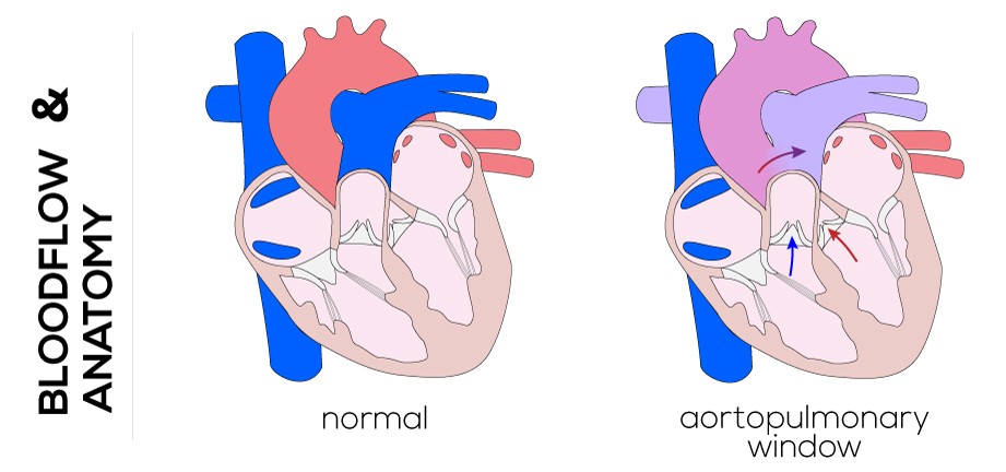 Aortopulmonary window (APW)