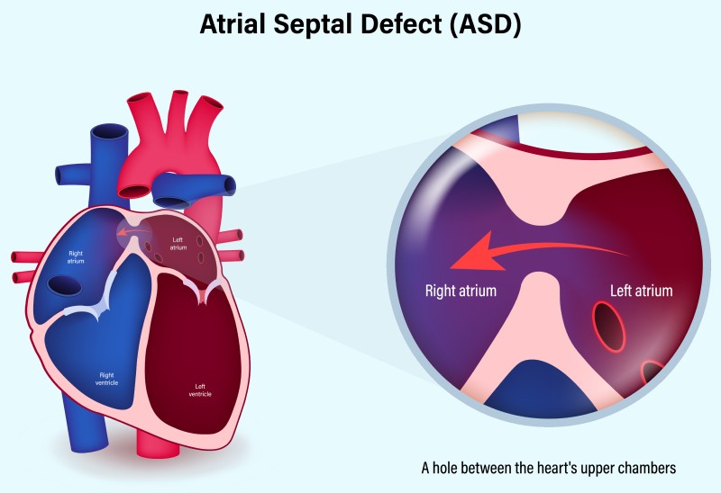 Atrial septal defect (ASD)