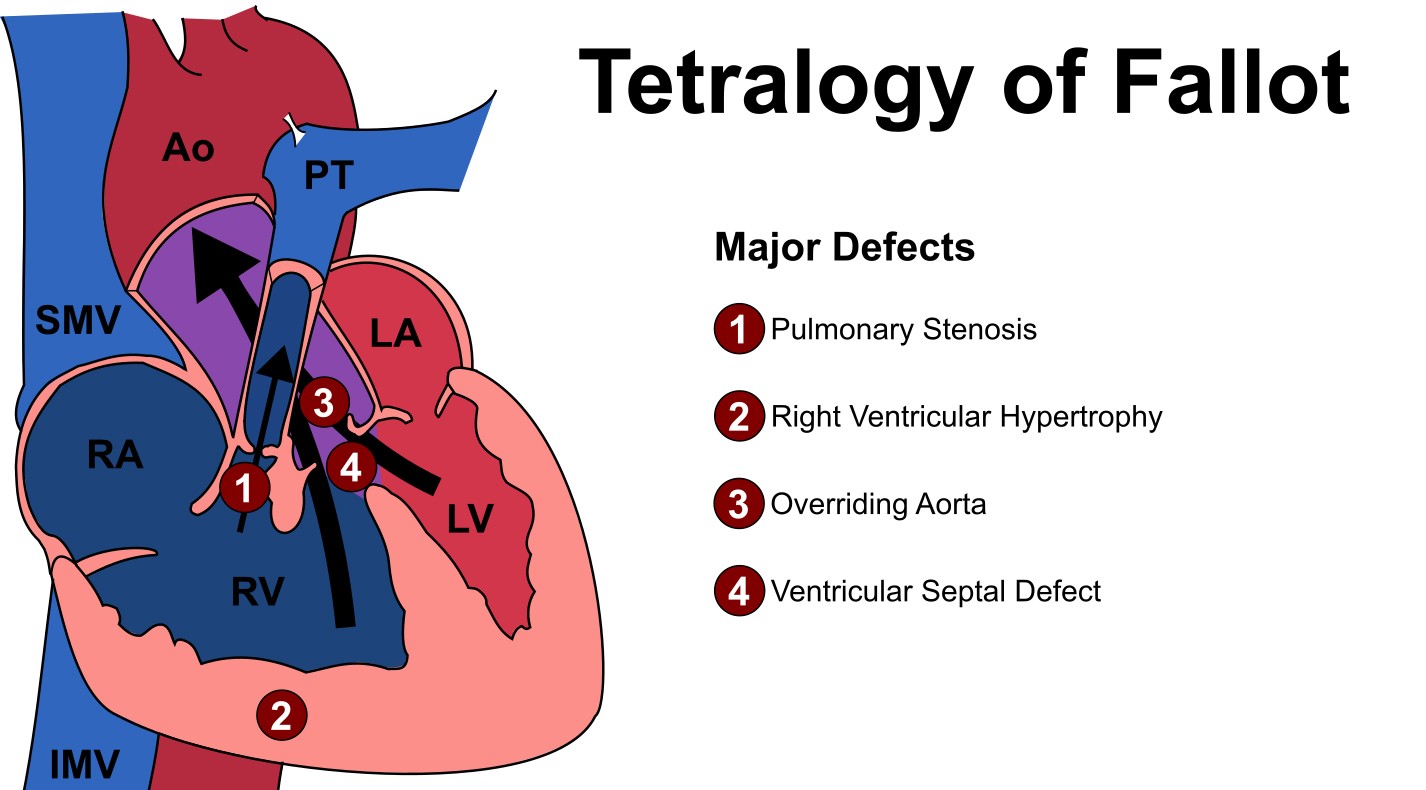 Aortopulmonary window (APW)