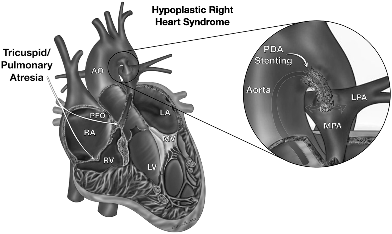Aortopulmonary window (APW)