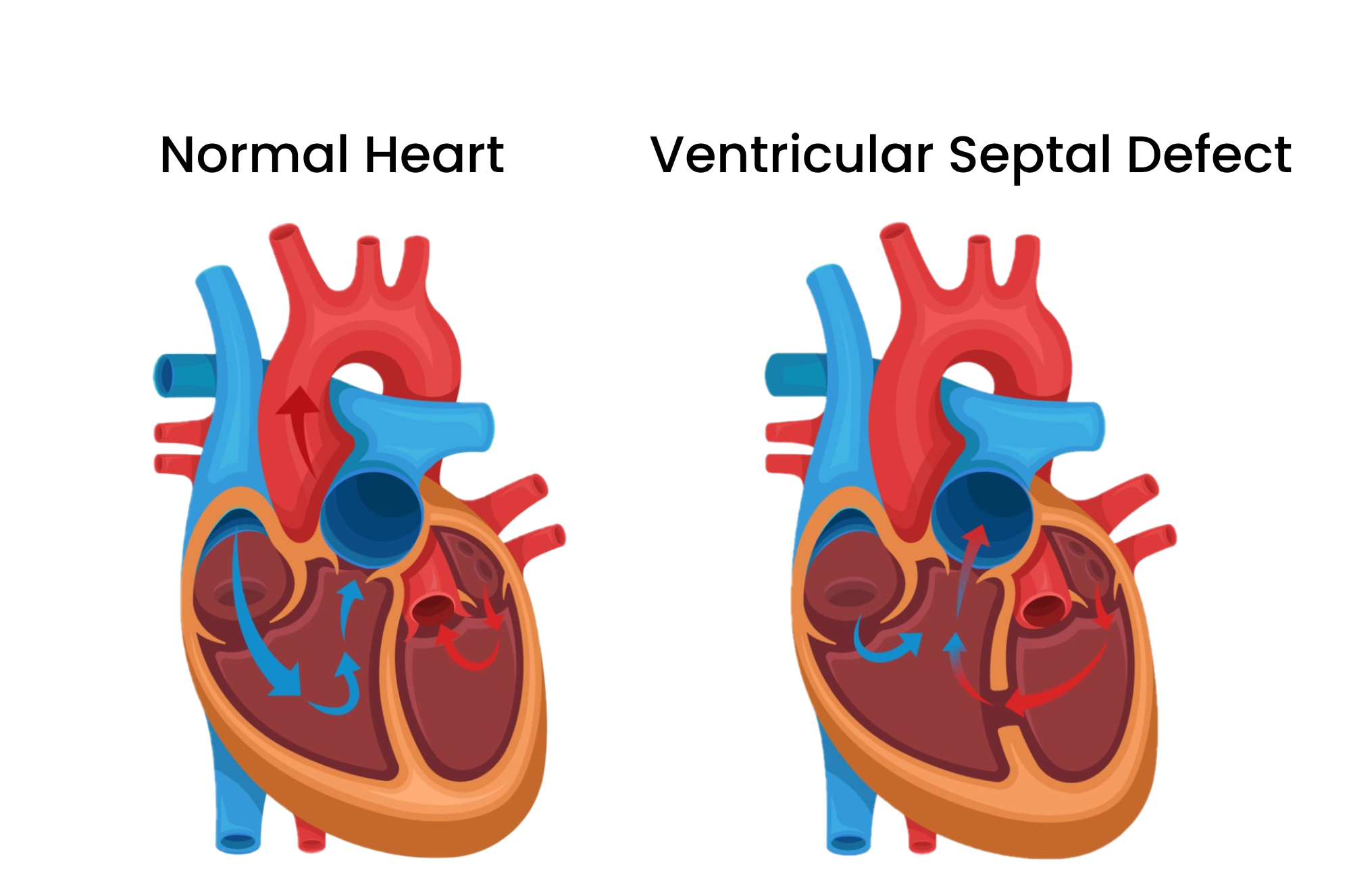 Ventricular septal defect (VSD)